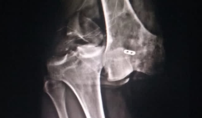 Vaquinha pra ajudar o Suel