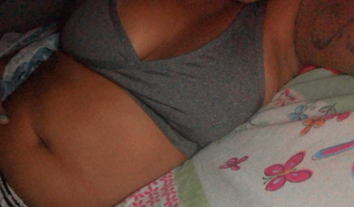 Cirurgia para Correção da Diástase Abdominal