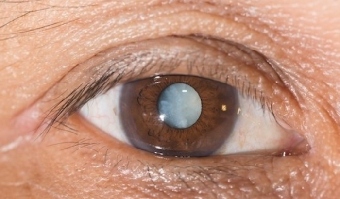 Cirurgia nos olhos, falta de visão olho direito.