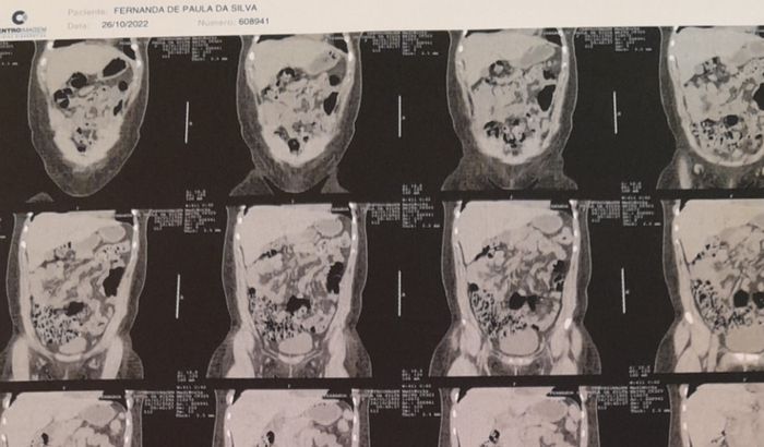 Cirurgia pra retirar calculo renal