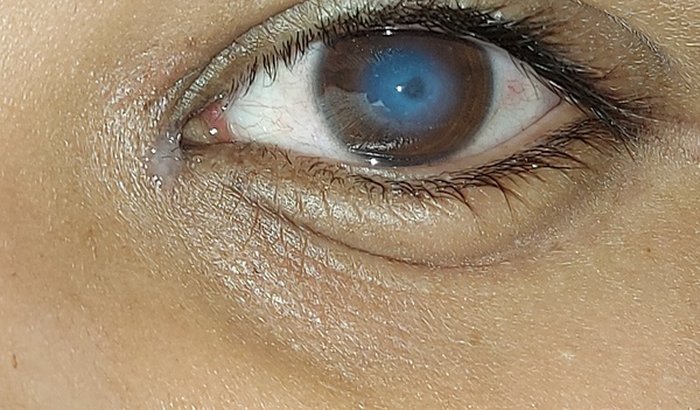 Tratamento da ceratocone do meu filho Luis 