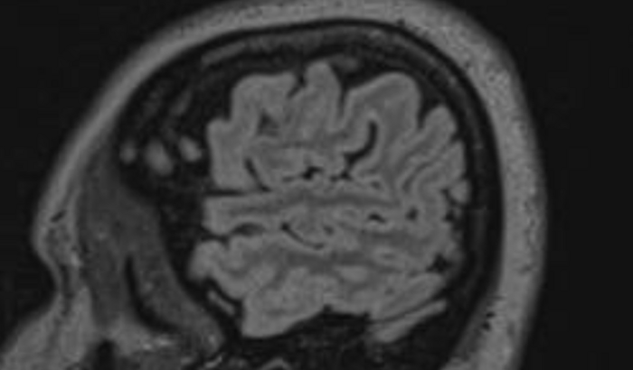 Tratar e ajudar a pagar meus exames de um pseudotumor cerebral