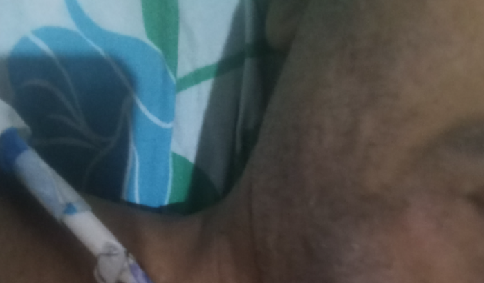 Implantação de fístula-hemodiálise 