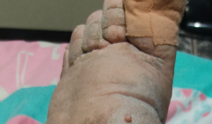 Ajuda no tratamento de linfedema da minha perna