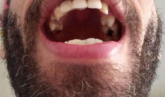 IMPLANTES DENTÁRIOS