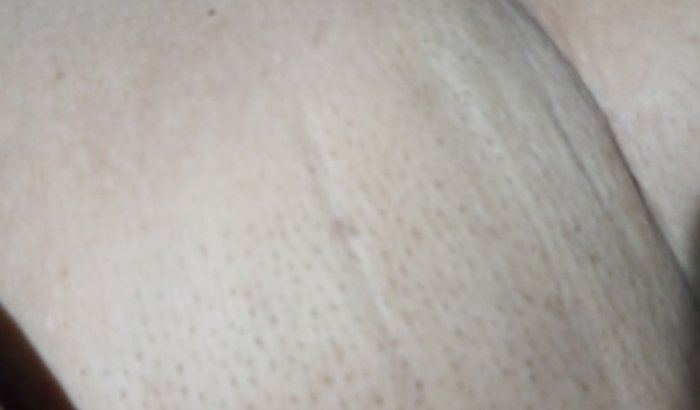 ajuda para Noemia  a fazer biopsia e cirurgia de tumorações axilar