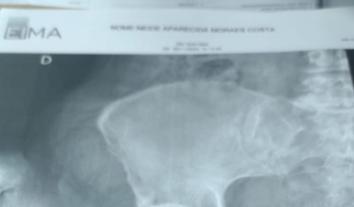 Reabilitação de fêmur para minha mãe