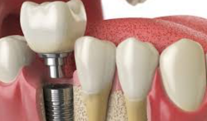 Ajude a comprar meu enxerto e implante dentário