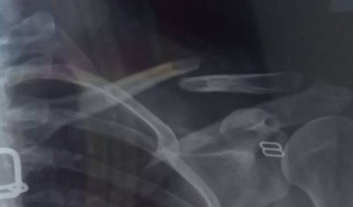 Cirugia de Emergência da clavícula 