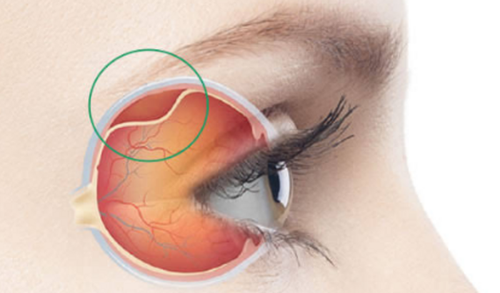 Cirugia de Descolamento de Retina