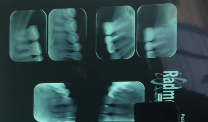 Cirurgia devido a perca Óssea 