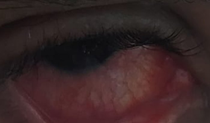 VITRECTOMIA OLHO DIREITO, CLÁUDIO