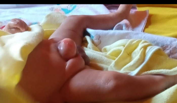 Tratamento cirúrgico do Arthur 