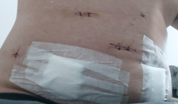 Retorno ao meu restaurante depois de uma cirurgia de retirada total do rim direito .