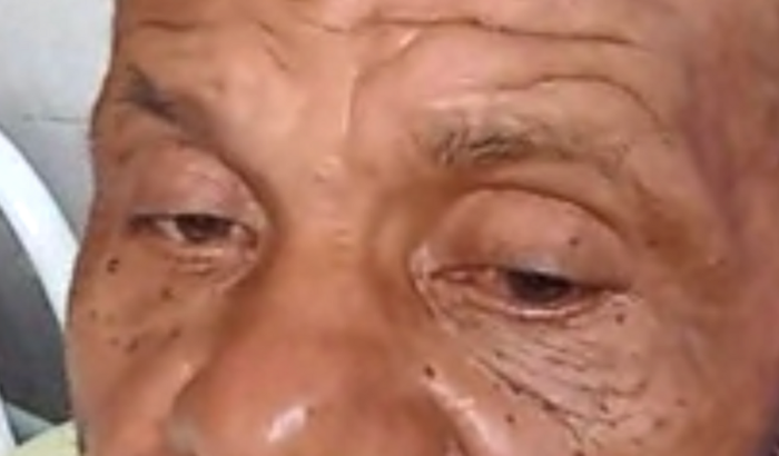 CIRURGIA DE CATETERISMO