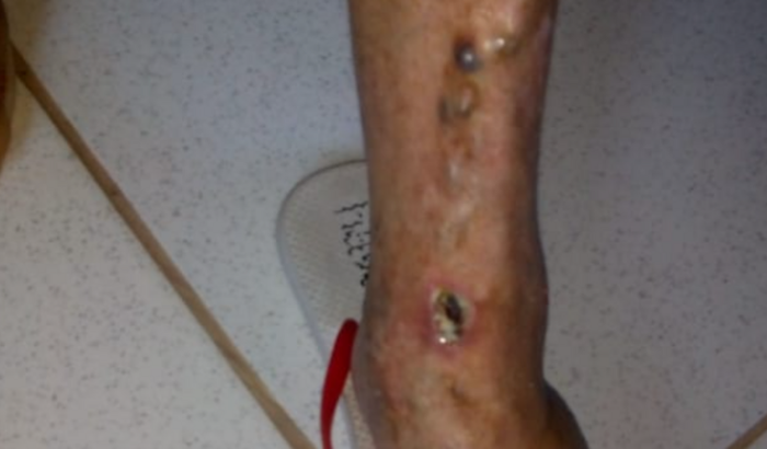 Ajude Rosa,A fazer uma cirurgia de Venosa.