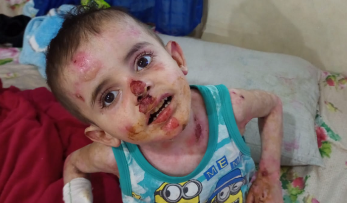 Tratamento do Benício