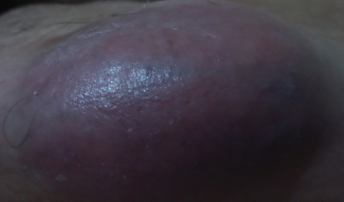 Exames e biópsia por conta de um tumor