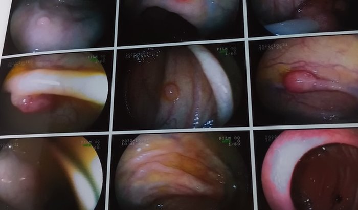 Cirugia para retirada Pólipos no intestino