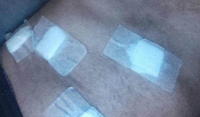 Viajem pós cirurgia 