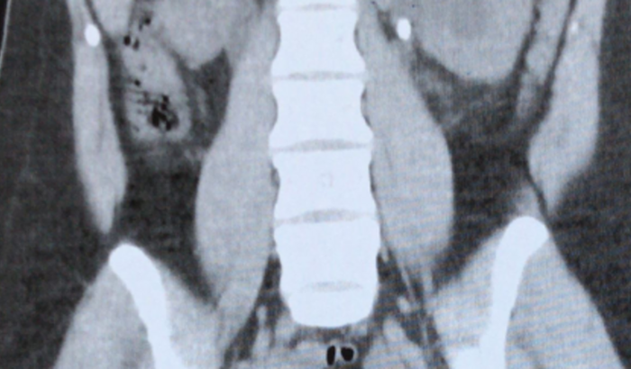 Preciso fazer uma cirurgia ureterorrenolitotripsia flexível unilateral.Venho passando muito mal por esses dias