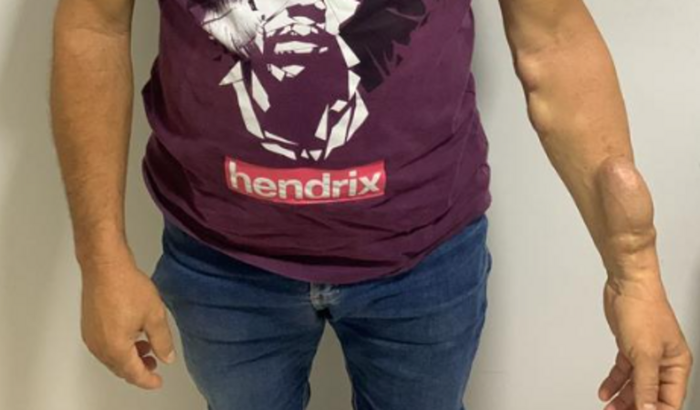 Tratamento para transplante de rins do Chico