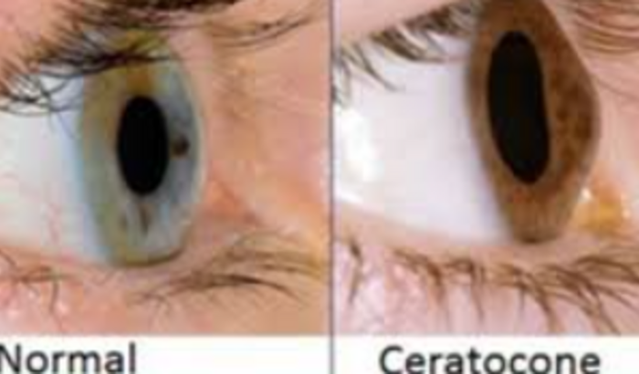 Em busca de uma visão melhor