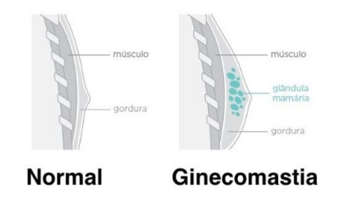 Ajuda para fazer cirurgia de ginecomastia 