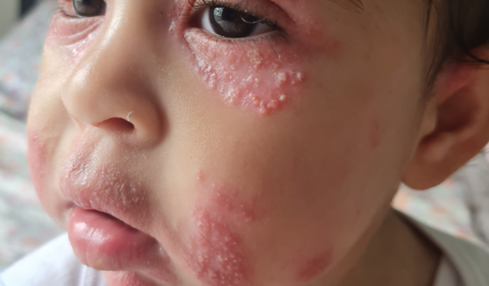 Ajudar nos remédios da valentina