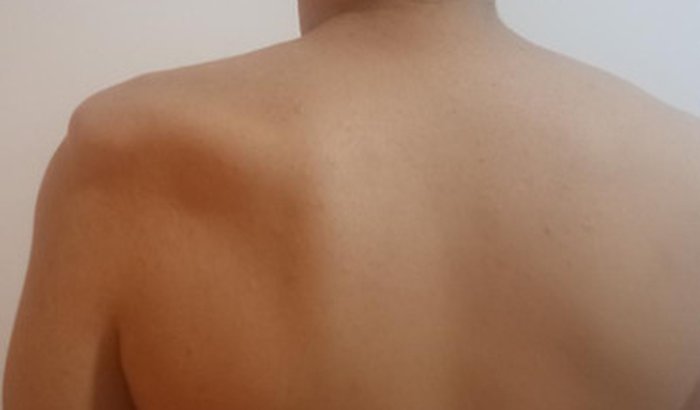 Ajuda para Cirurgia do braço de Ferreirinha