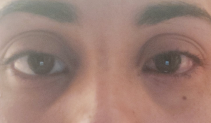 Ajuda pra cirurgia de miopia e astigmatismo