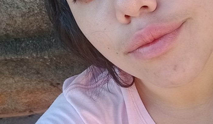 Ajuda para vitória Regina 21 anos, cirugia de reconstrução de pele em uma cirurgia na barriga ao abrir 