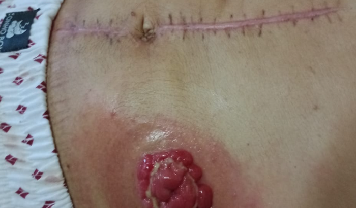 Tratamento de câncer 