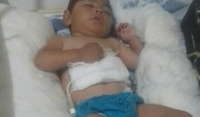 Daniel precisa de uma sonda botton com balonete frente 12