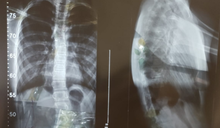 Compra de Colete 3D para tratamento de escoliose