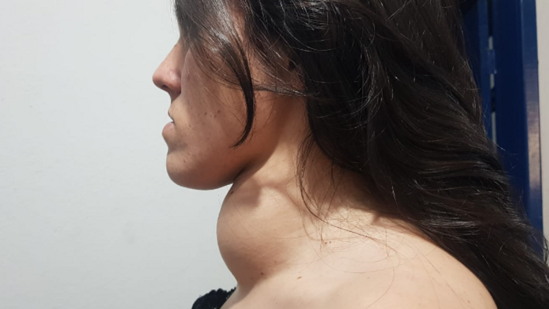 imagem da vaquinha Cirurgia tireoidectomia total 