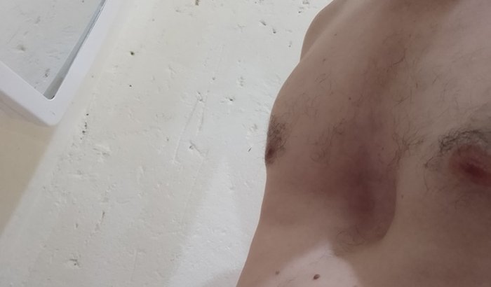 Ortese pectus excavatum (Vacuum Bell) pix61996610523