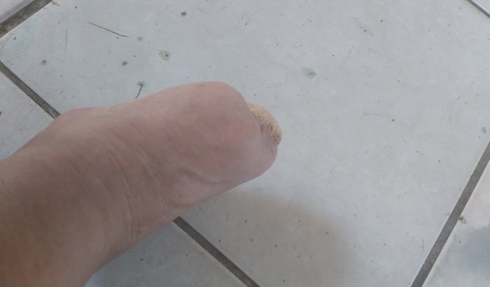 Prótese para amputação de antepé