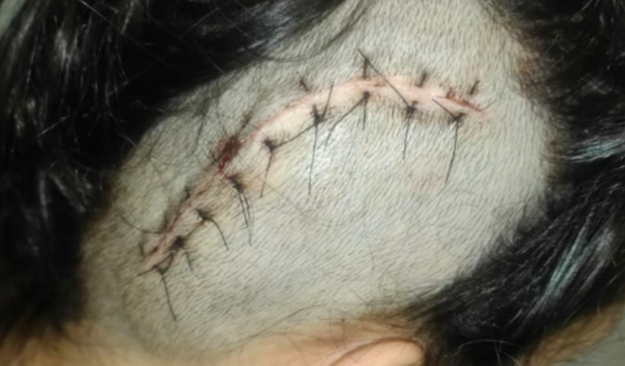 Hidrocefalia Crônica de Gracielle