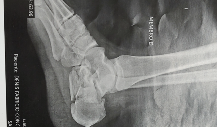 Cirurgia urgente por fratura grave de calcâneo