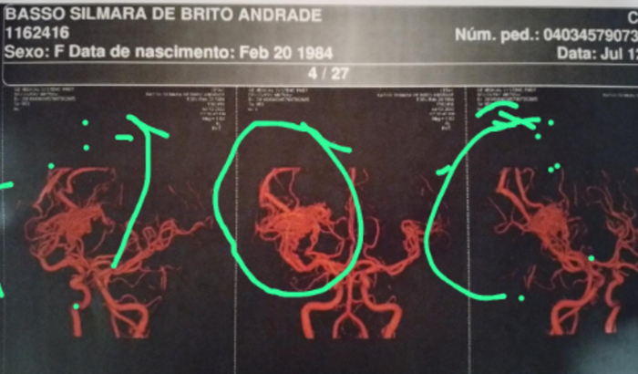 Ajuda para cirurgia cerebral para tratamento de MAV