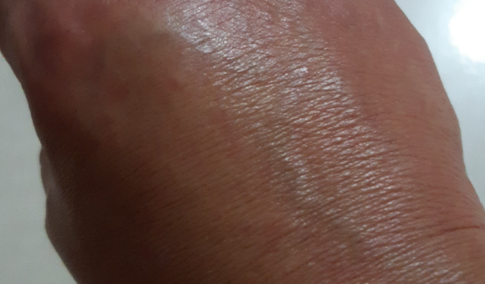 Preciso de ajuda,cirurgia para corrigir sindrome de Quervein
