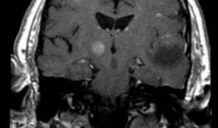 Tumor Intracraniano