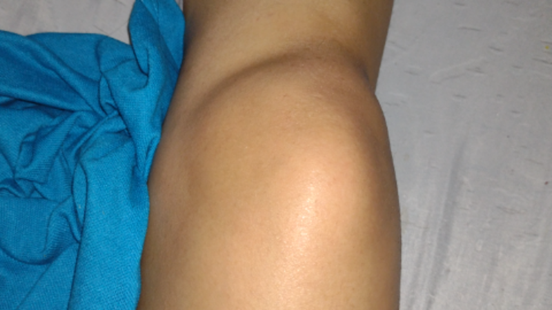 Cirurgia de joelho. Reconstrução de ligamento mais osteotomia 