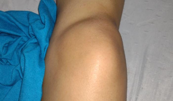 Cirurgia de joelho. Reconstrução de ligamento mais osteotomia 