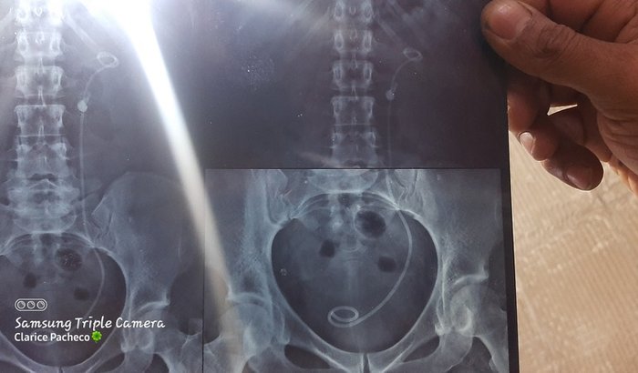 Retirada do catater e Litrotrepsia 