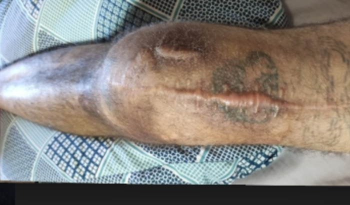 Ajuda para cirurgia de joelho