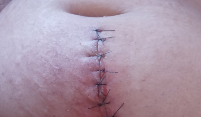 Cirurgia de apendicite 