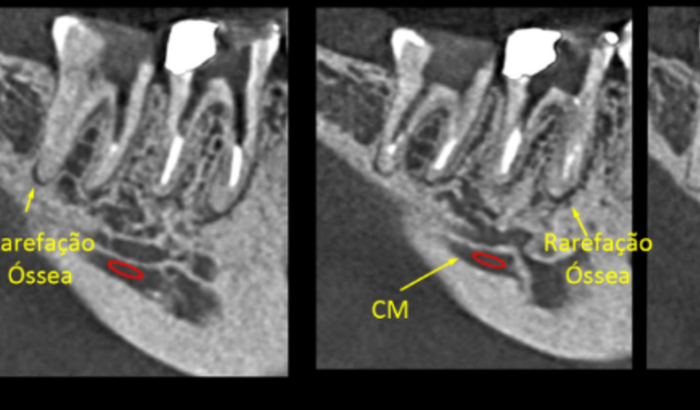 Tratamento Periapical 