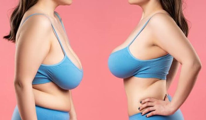 Me ajuda a fazer um cirurgia de mamoplastia